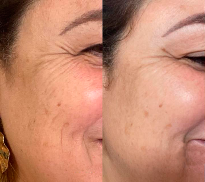 Antes e Depois Anti-Idade